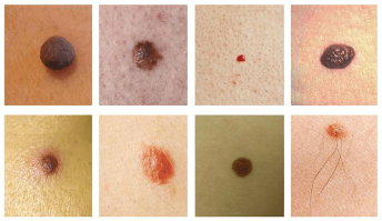 The most common are spots on the skin is a birthmark, and human papilloma (warts)