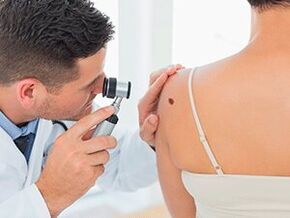 the doctor examines the papilloma on recommends removal with drugs