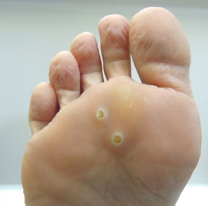 how to get rid of wart on foot
